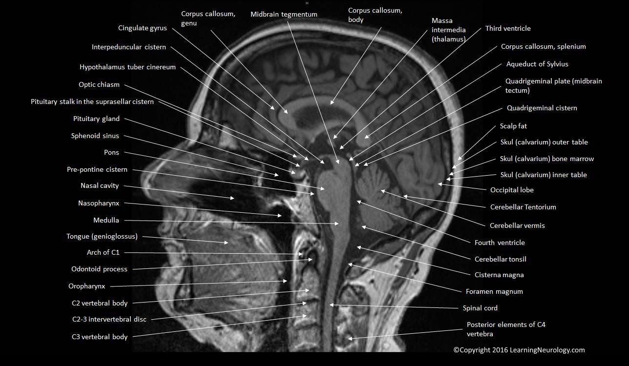 Normal MRI brain in mid-sagittal plane, T1, with structures labeled (click image to enlarge)